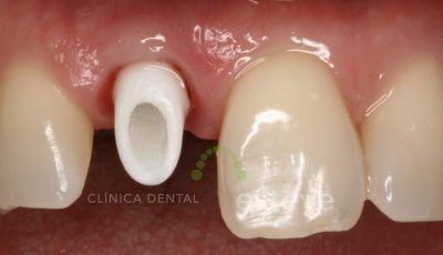 Los Implantes Dentales