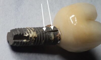 Guía completa sobre implantes dentales: desde la evaluación hasta la recuperación