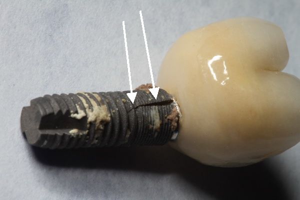 Guía completa sobre implantes dentales: desde la evaluación hasta la recuperación